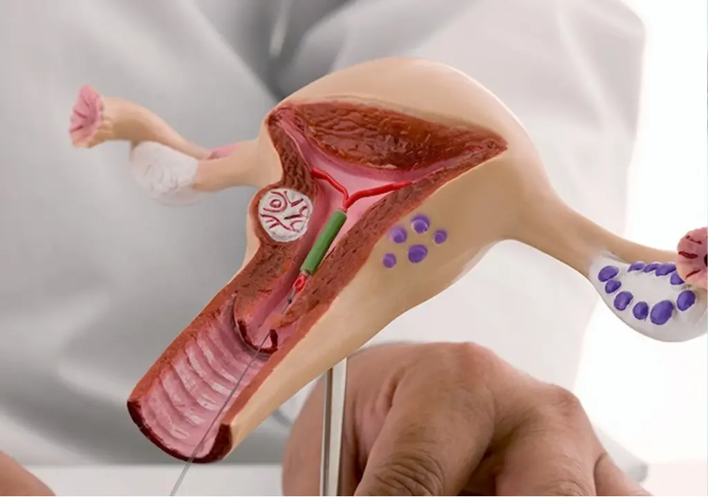 Intra Uterine Insemination IUI Treatment in Chennai